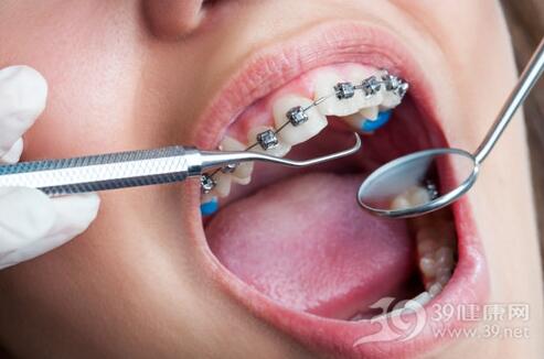 4类人可以考虑做牙齿正畸