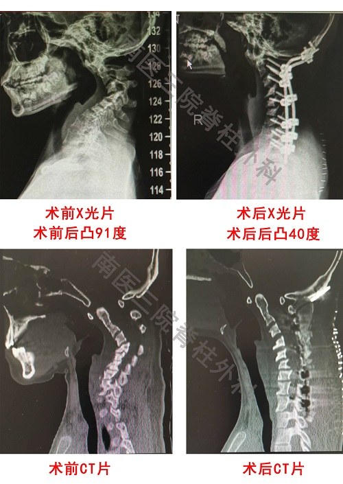 颈椎侧凸图片