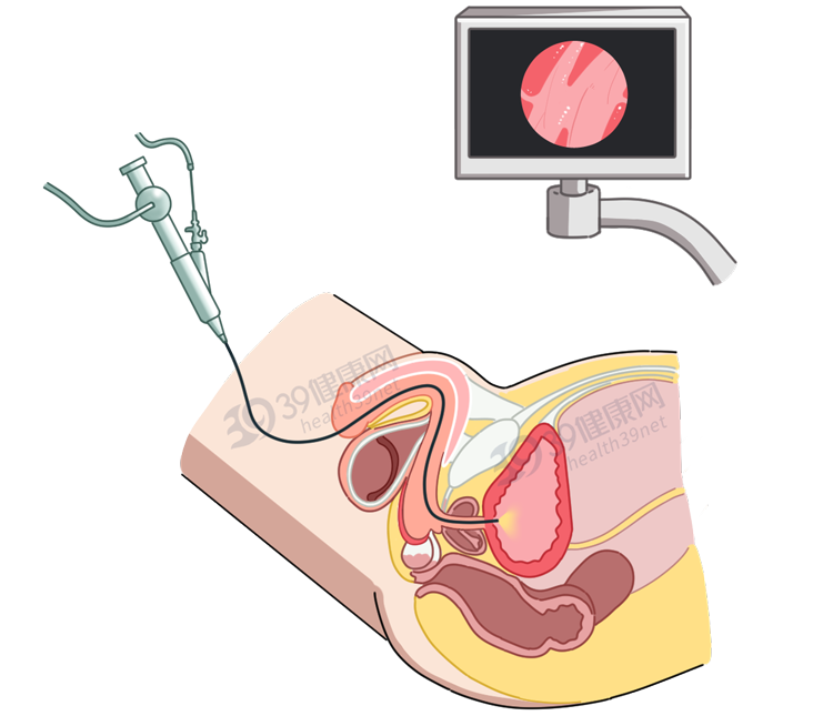 尿道镜检查图片