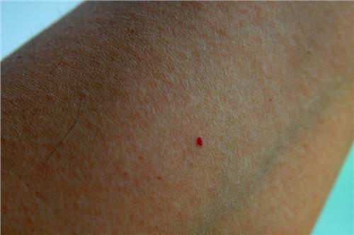 肝癌红痣图片 手臂图片